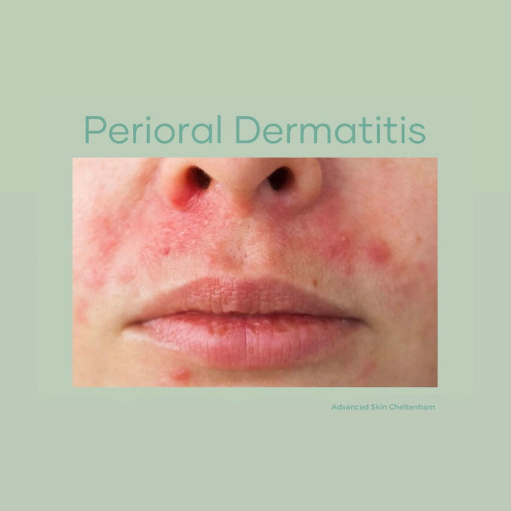 Perioral Dermatitis – Advanced Skin Cheltenham